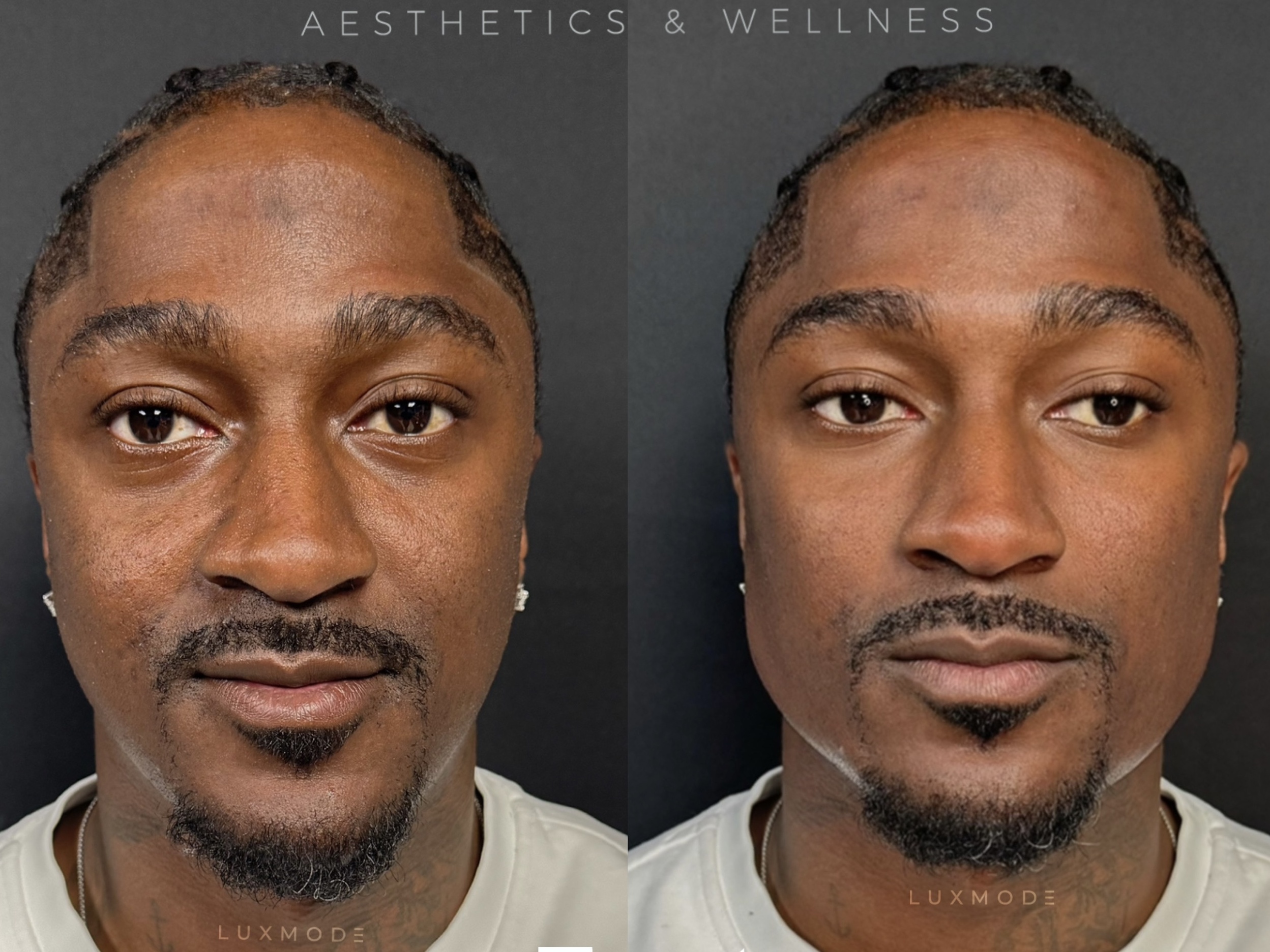 Are Black Men Getting Botox Now? Everything To Know About "Brotox"